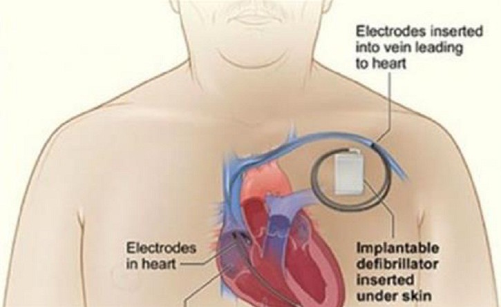 جهاز لاسلكي جديد لتنظيم ضربات القلب هو الأول من نوعه في أمريكا
