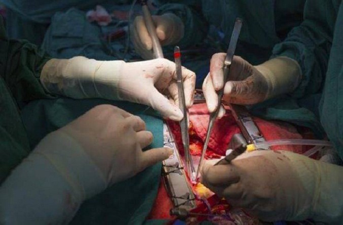 دراسة: استبدال الشريان بالقلب أفضل من الجراحة