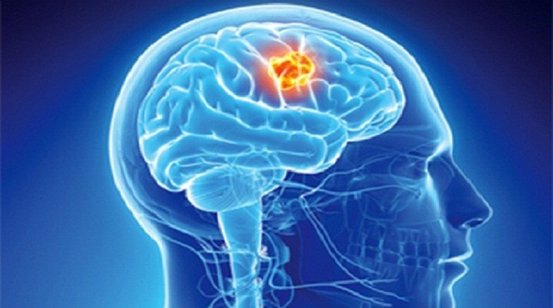 دراسة: التعليم الجامعي قد يسبب الإصابة بسرطان الدماغ