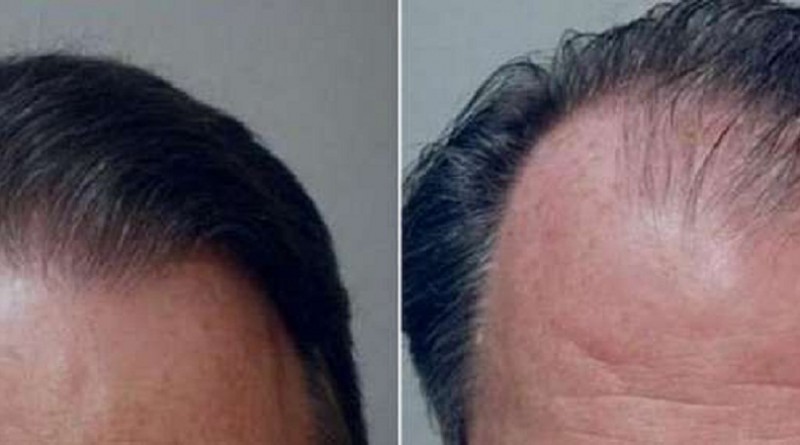 دراسة: زراعة الشعر تجعل الرجال يبدون أكثر جاذبية وأصغر سنا
