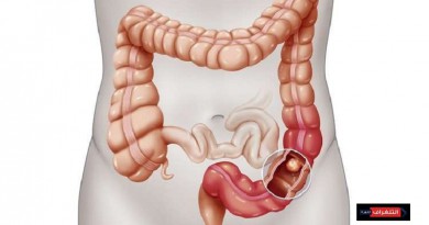 سرطان المعدة ينتقل "بالقُبل"