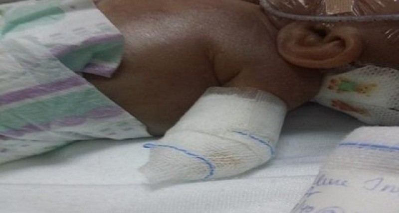 خطأ طبي يتسبب في وفاة طفل بعد سقوط يده من جسده