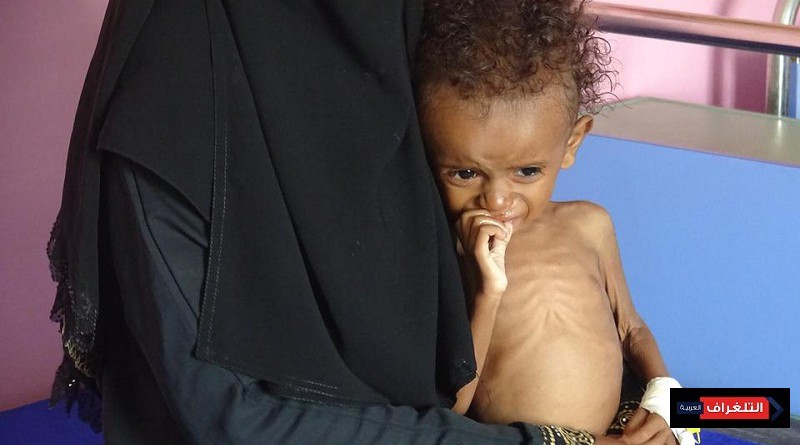 50 مليون شخص في المنطقة يعانون من "نقص التغذية"