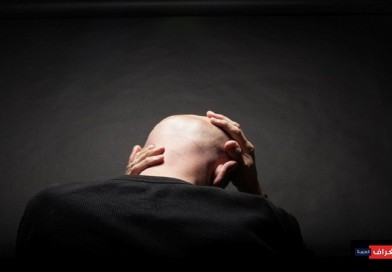 علاج رائد للصلع “ينهي” مأساة الرجال