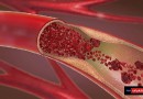 أعظم إنجاز في مجال الطب “دعامات الأوعية الدموية”