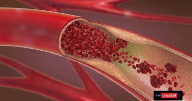 دعامات الأوعية الدموية