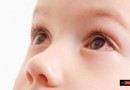 احمرار العيون عند الأطفال..اسبابه وعلاجه وطرق الوقاية منه