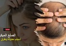 الصلع المبكر..أسباب حدوثه وطرق علاجه