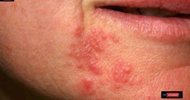 التهاب الجلد حول الفم ...أعراضه وكيفية علاجه طبيًا وبالاعشاب